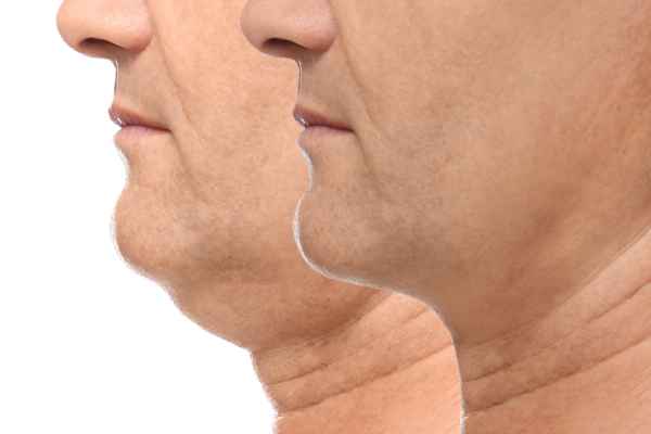 HIFU - Breakthrough in Anti - ageing 2 hifu results Doancaster