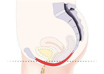 Pelvic-Floor Muscle Repair 5 Pelvic floor muscles Doancaster