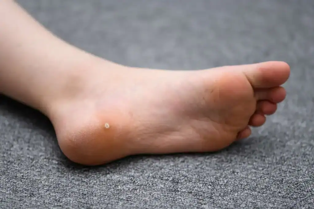 Cryotherapy For Warts And Also Verrucas 2 Image of verruca on the bottom of the foot that able to be treated with Cryotherapy Doancaster
