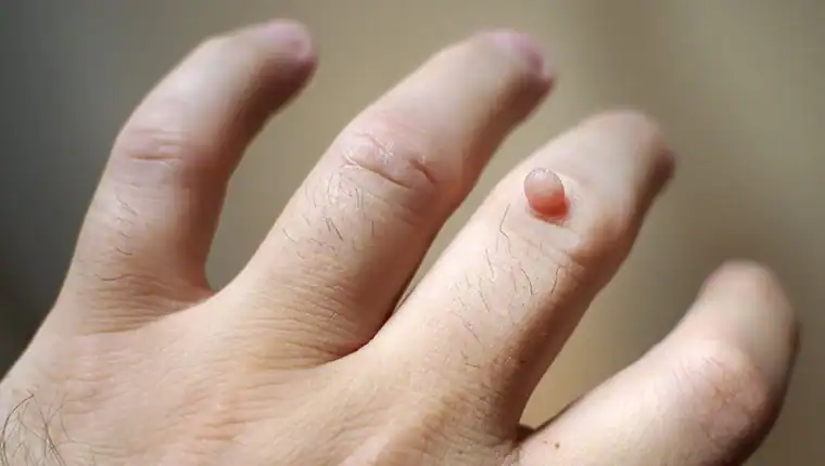 Image of blemish that Cryotherapy Doancaster can remove with Lipo 360.