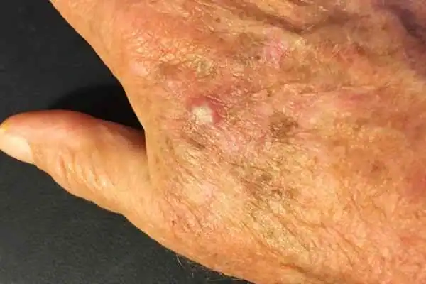 Image of Actinic keratoses Doancaster on a person hand