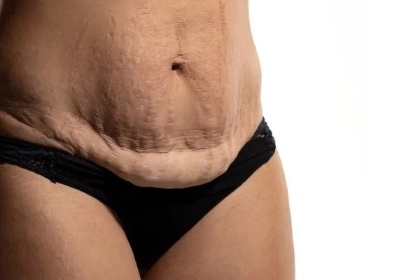 The Science of Skin Tightening 1 The science behind skin tightening Doancaster picture of a woman's sagging skin on the stomach